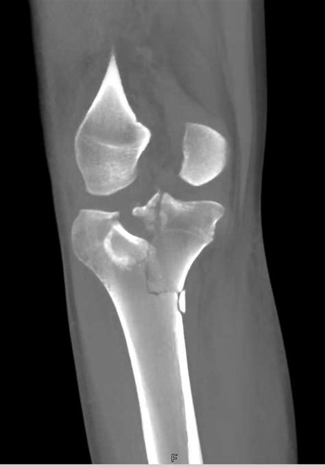 Tibial Plateau Fracture Musculoskeletal Case Studies Ctisus Ct Scanning
