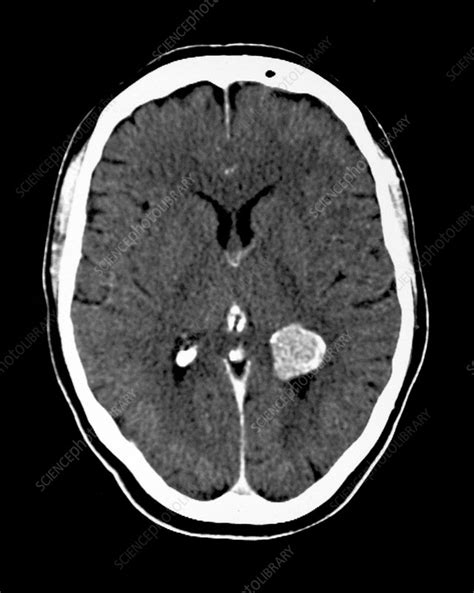 Ct Scan Of Meningioma Stock Image M2100392 Science Photo Library