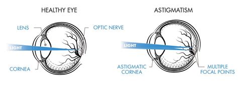 What Is Astigmatism Symptoms And Treatments Lenscrafters