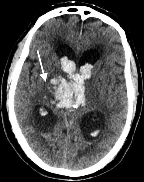 Imaging Of Spontaneous Intracerebral Hemorrhage Radiology Key