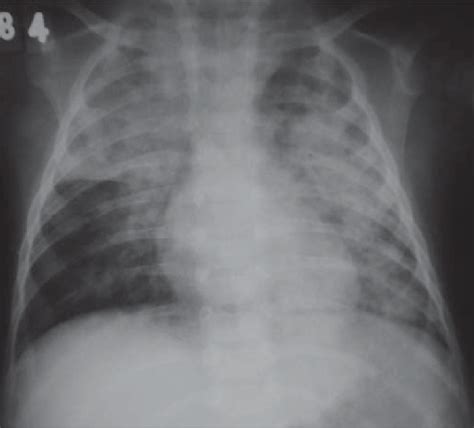 Anteroposterior View Of Chest In A Three Year Old Boy Undergoing