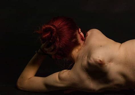 This Woman With Scoliosis Posed Topless In A Stunning Photoseries To