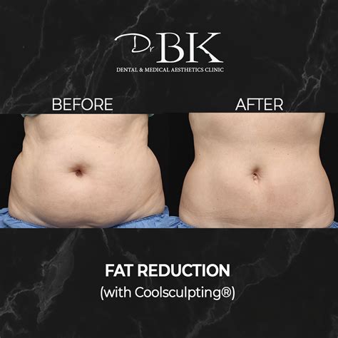 Coolsculpting® Fat Freezing Treatment Drbk Clinic In Reading