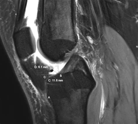2d And 3d Mris Provide Reliable Measurements For Planning Acl Surgery