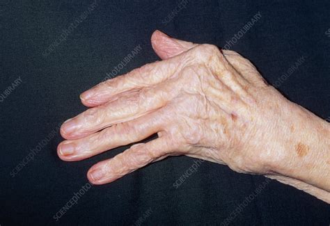 Hand Of Elderly Woman With Rheumatoid Arthritis Stock Image M110