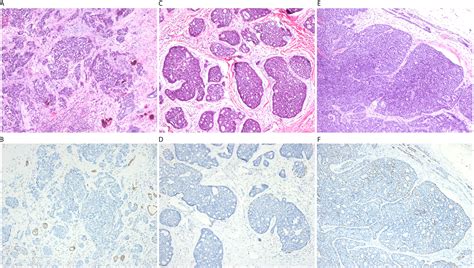 Frontiers Exploration Of High Grade Transformation And Postoperative