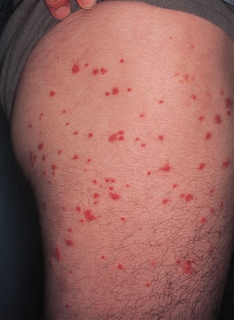 Pruritic Urticarial Papules Of The Thighs And Groin Allergy And Clinical Immunology Jama