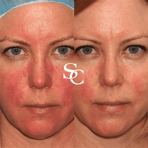 Rosacea Treatment Melbourne By Skin Club Cosmetic Doctors