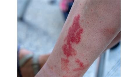 Hikers Rash What Is It Exploring The Causes Symptoms And Treatment
