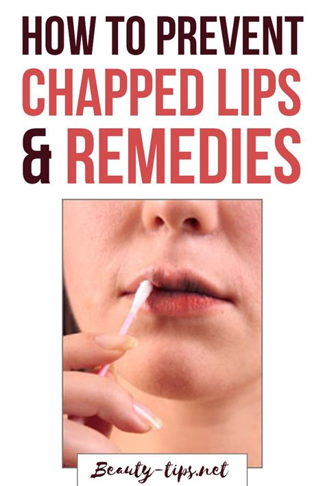 Chapped Lips Causes How To Prevent And Remedies For Dry Lips Chapped
