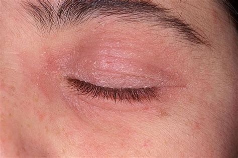 Itchy Skin On Eyelids And Behind Ears