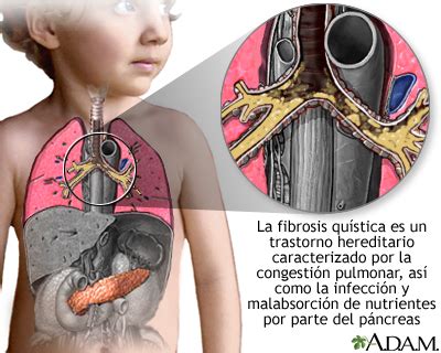 Enfermedades infecciosas y microbiologia clinica. la fibrosis quística - Algunas curiosidades