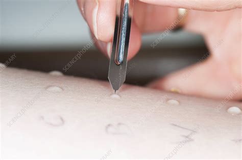 Skin Prick Allergy Test Stock Image C0150361 Science Photo Library