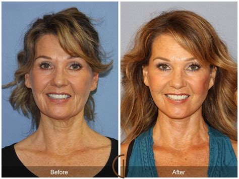 Facelift Fifties Before And After Photos Patient 32 Dr Kevin Sadati