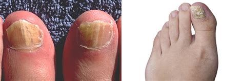 What Is The Fastest Way To Cure Toenail Fungus