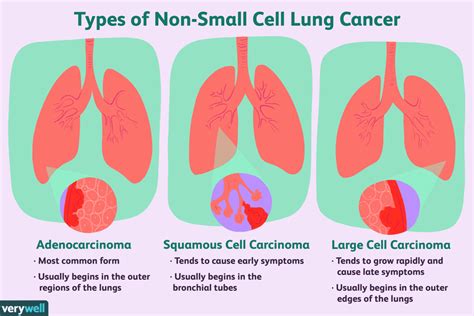 the most common types of lung cancer