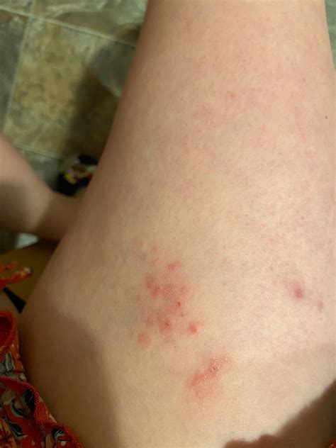 Anyone Any Idea What This Rash Could Be On The Top Of My Thigh
