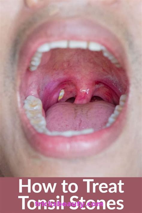 How To Get Rid Of White Spots On Tonsils