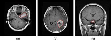 Illustrations Of Three Typical Brain Tumors A Meningioma B Glioma