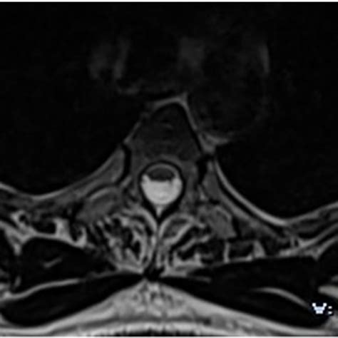 Axial Section Of A Thoracic Spinal Cord Mri On T2 Wi At The Level Of T8
