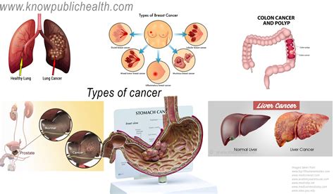 Types Of Cancer Breast Cancer Bladder Cancer Lung Cancer