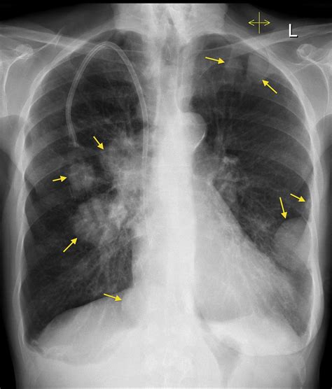lung metastases breast cancer radiology at st vincent s university hospital