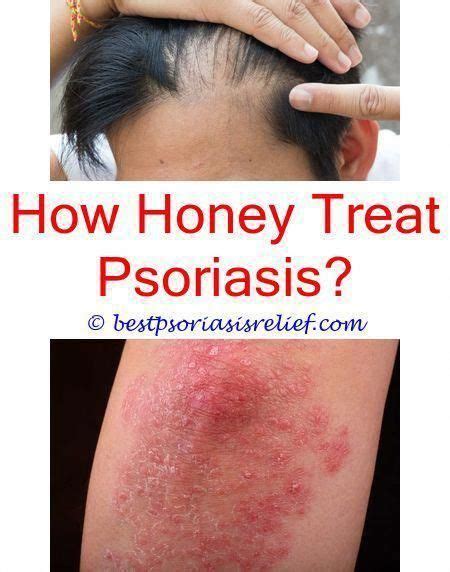 Scalppsoriasistreatment Psoriasis Treatment Plaque Psoriasis