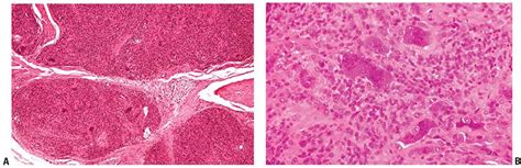 Tumors Of Fibrous Tissue Involving The Skin Plastic Surgery Key