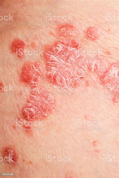 Psoriasis Psoriatic Skin Disease Stock Photo Download Image Now