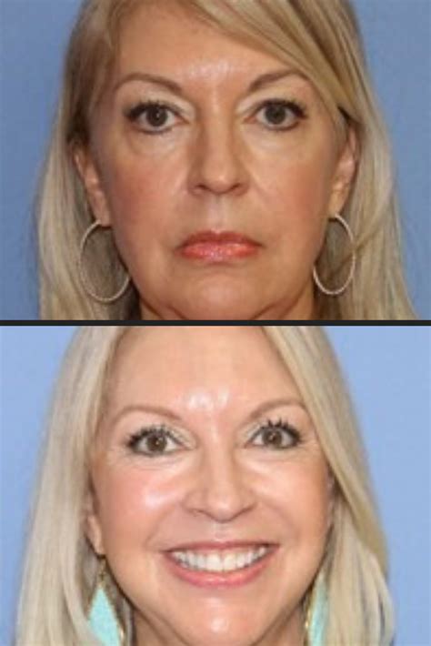 Botox Before And After Women Over 50
