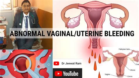 Abnormal Vaginaluterine Bleeding Signs Symptoms Causes And Management Youtube