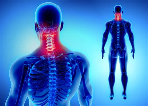 How To Treat Cervical Radiculopathy Best Physical Therapy Nyc