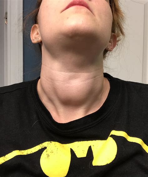 Persistent Goiter With Normal Labs Hypothyroidism