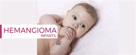 Hemangioma Infantil Em Botucatu Dra Paula Angeleli Cirurgia Vascular