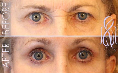 Lower Eyelid Lift Blepharoplasty Eyelid Surgery In Atlanta Ga