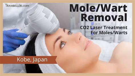 Molewart Removal Co2 Laser Treatment For Moleswarts Trambellir