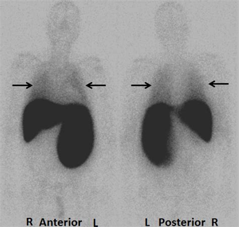Diagnosis Of Diffuse Pulmonary Extramedullary Hematopoiesis In