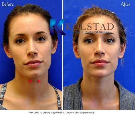 Liquid Chin Augmentation Near Me To Correct Chin Dimple Before And After