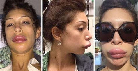 19 Freaky Cases Of Lip Injections Gone Wrong