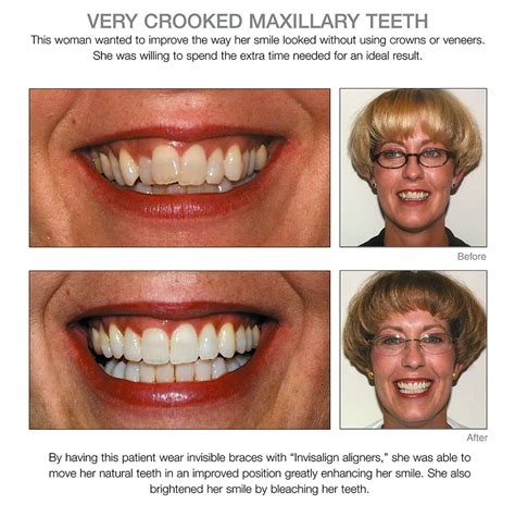Porcelain Veneers For Crooked Teeth Before And After My Xxx Hot Girl