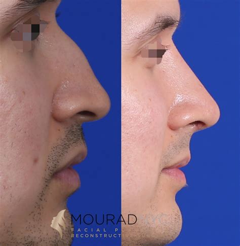 Saddle Nose Deformity Facial Plastic Surgeon