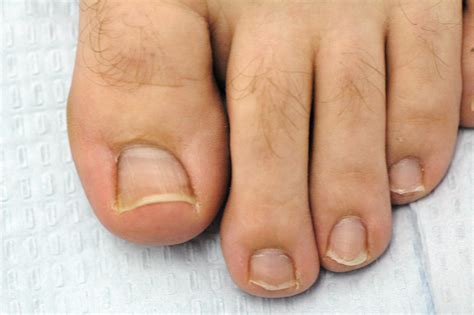 Mortons Toe What Is It What Causes It How To Treat It
