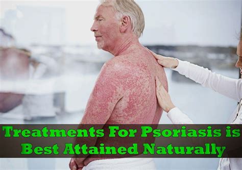 Treatments For Psoriasis Is Best Attained Naturally 9 Med Psoriasis