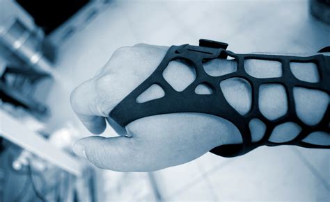 Are 3d Printed Casts The Right Choice For You