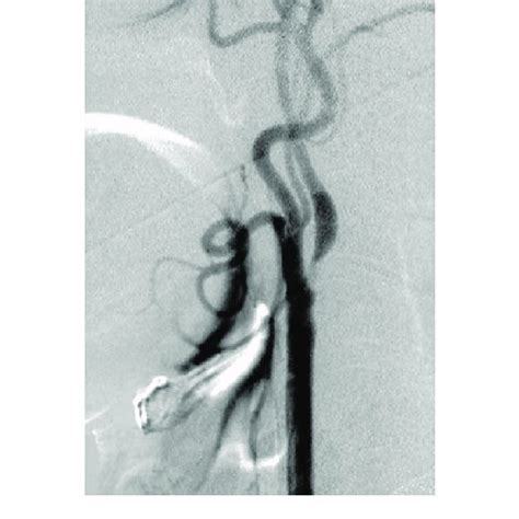 Left Carotid Angiogram Lateral View Showing 95 Stenosis At The