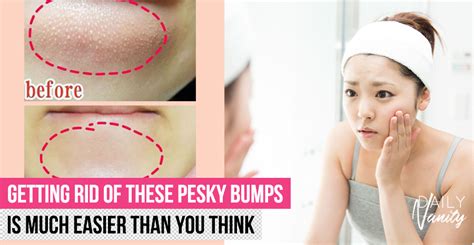 Do You Have Bumps On Your Chin Here Are 5 Ways To Get Rid Of Closed