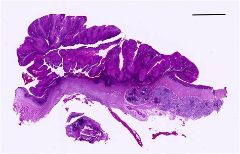 The Histopathology Of Proliferative Verrucous Leukoplakia Diagnostic
