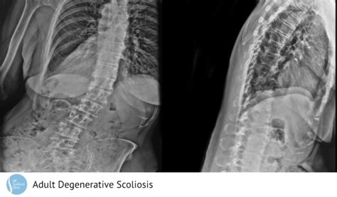 Adult Scoliosis Archives Scoliosis Clinic Uk Treating Scoliosis
