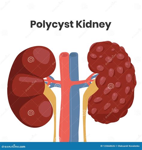 Vector Illustration Of The Polycystic Kidney Disease Stock Vector