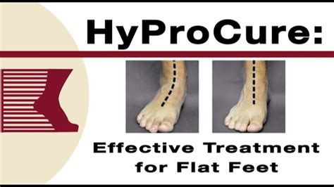 Hyprocure Effective Treatment For Flat Feet Youtube